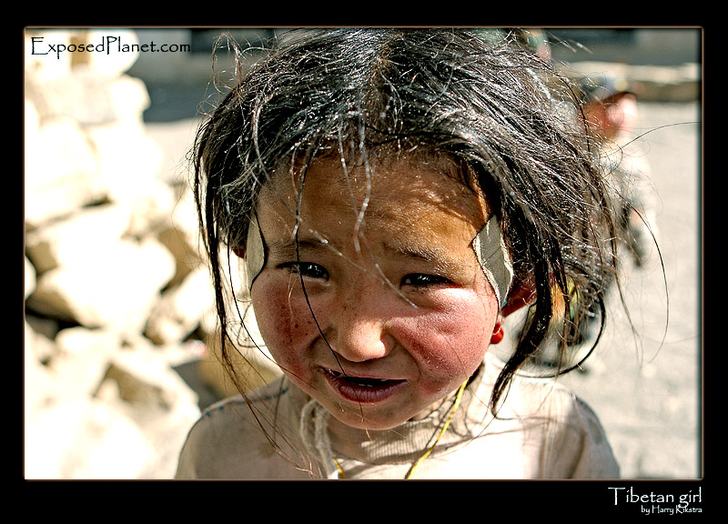Tibetan girl with bandaids