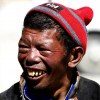 Tibetan man in Tingri in need of dental care