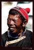 Tibetan man in Tingri in need of dental care